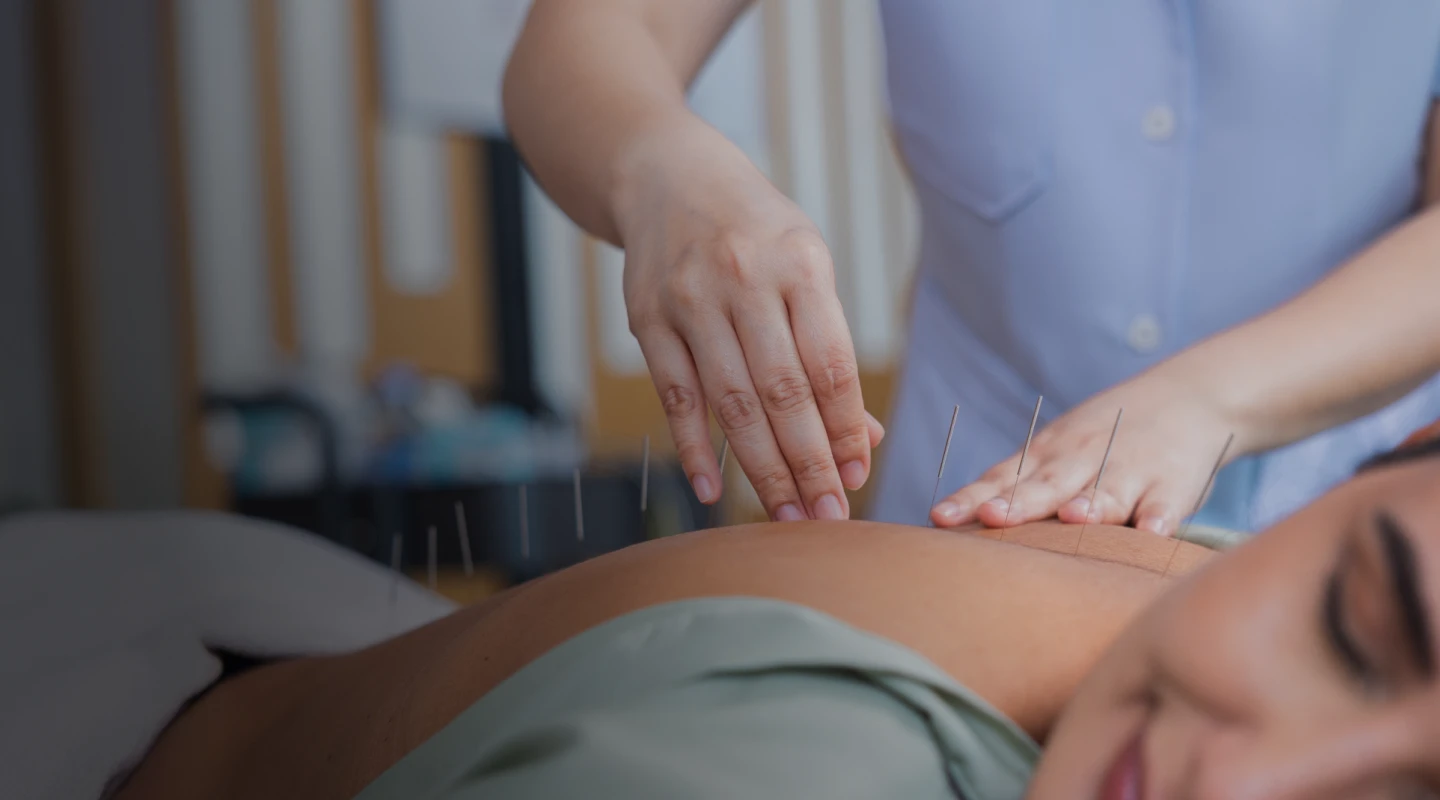 Acupuncture